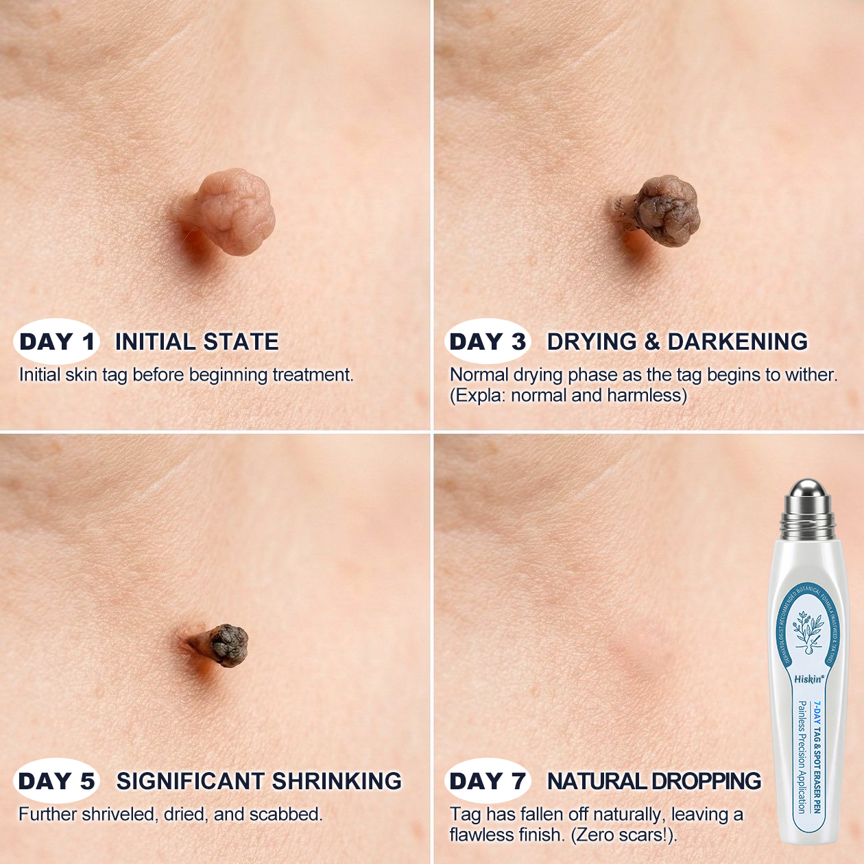 ✨ Exclusive 30% OFF 💎 Official Hiskin® Store | 7-Day Tag & Spot Eraser | Professional-Quality Rollerball | Zero Pain • Zero Scars • Safe for Face & Body