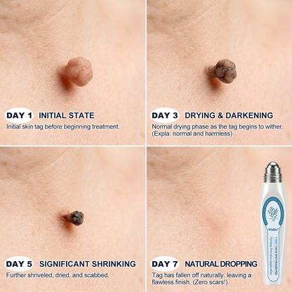 ✨ Exclusive 30% OFF 💎 Official Hiskin® Store | 7-Day Tag & Spot Eraser | Professional-Quality Rollerball | Zero Pain • Zero Scars • Safe for Face & Body