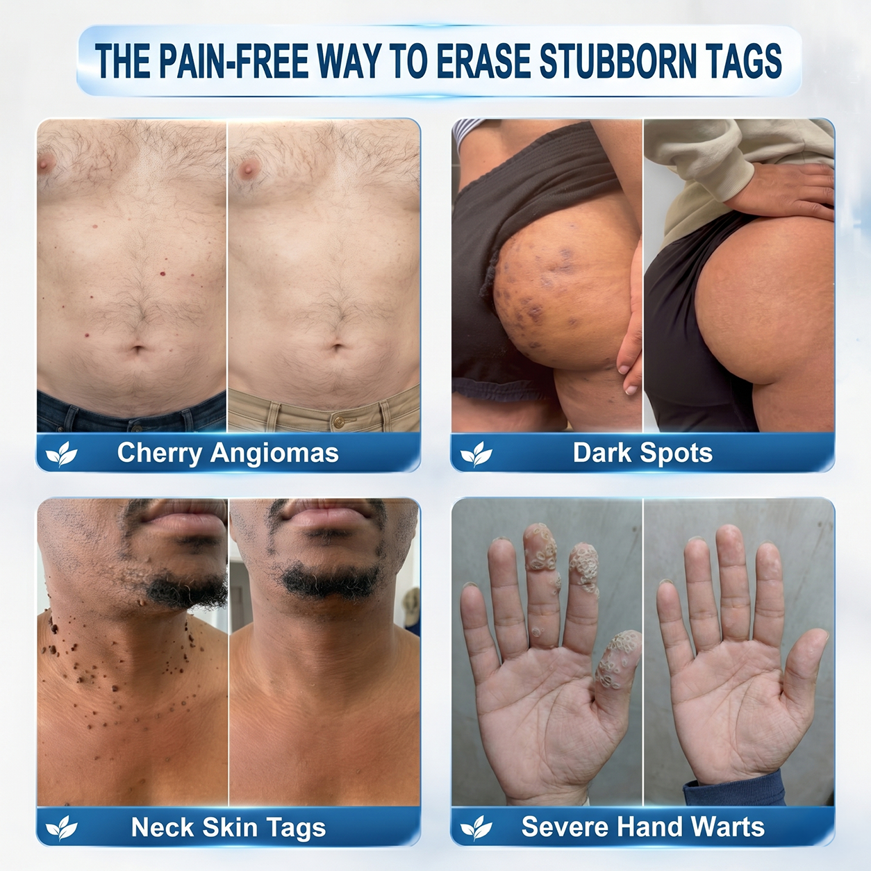 ✨ Exclusive 30% OFF 💎 Official Hiskin® Store | 7-Day Tag & Spot Eraser | Professional-Quality Rollerball | Zero Pain • Zero Scars • Safe for Face & Body